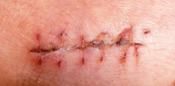 Huge Scars