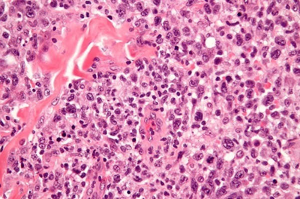 Anaplastic Large Cell Lymphoma