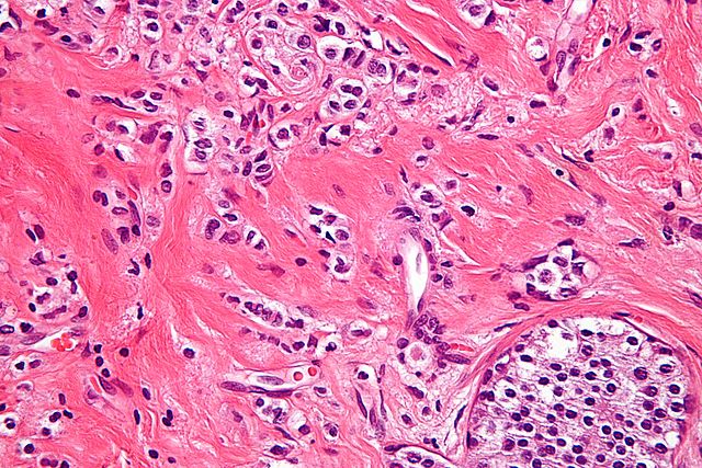 Lobular Carcinoma