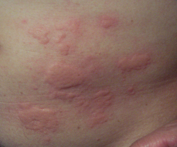 Rashes