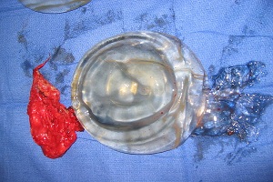 implants entirely removed