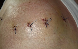 stitches