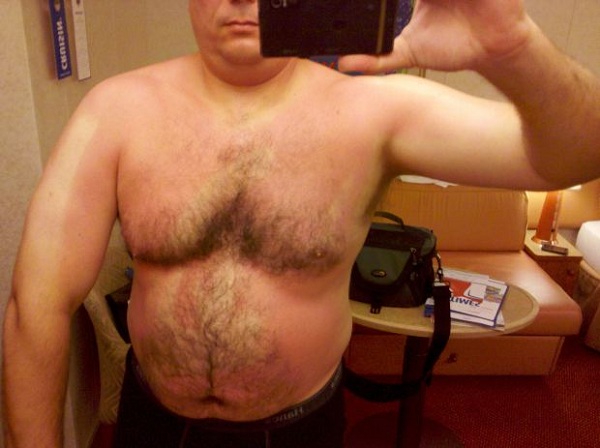 men suffer from abnormally large and fatty breasts