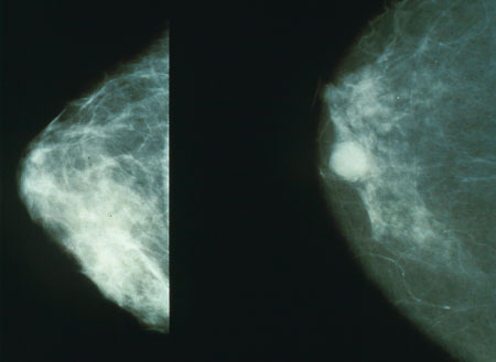 Mammography Images